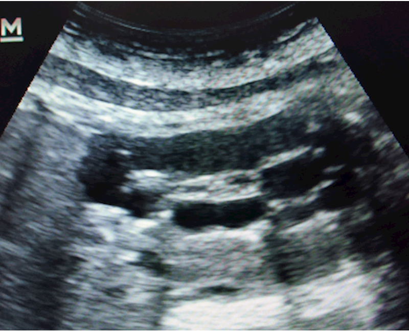 Prenatal diagnosis of multicystic dysplastic kidney with contralateral pelviureteric junction obstruction on ultrasound